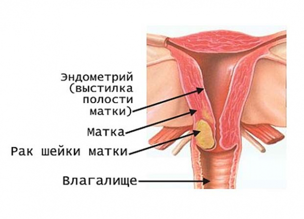 Как выглядит рак молочных желез