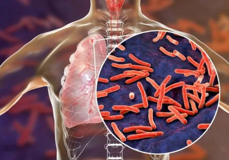 Методы лечения Туберкулеза